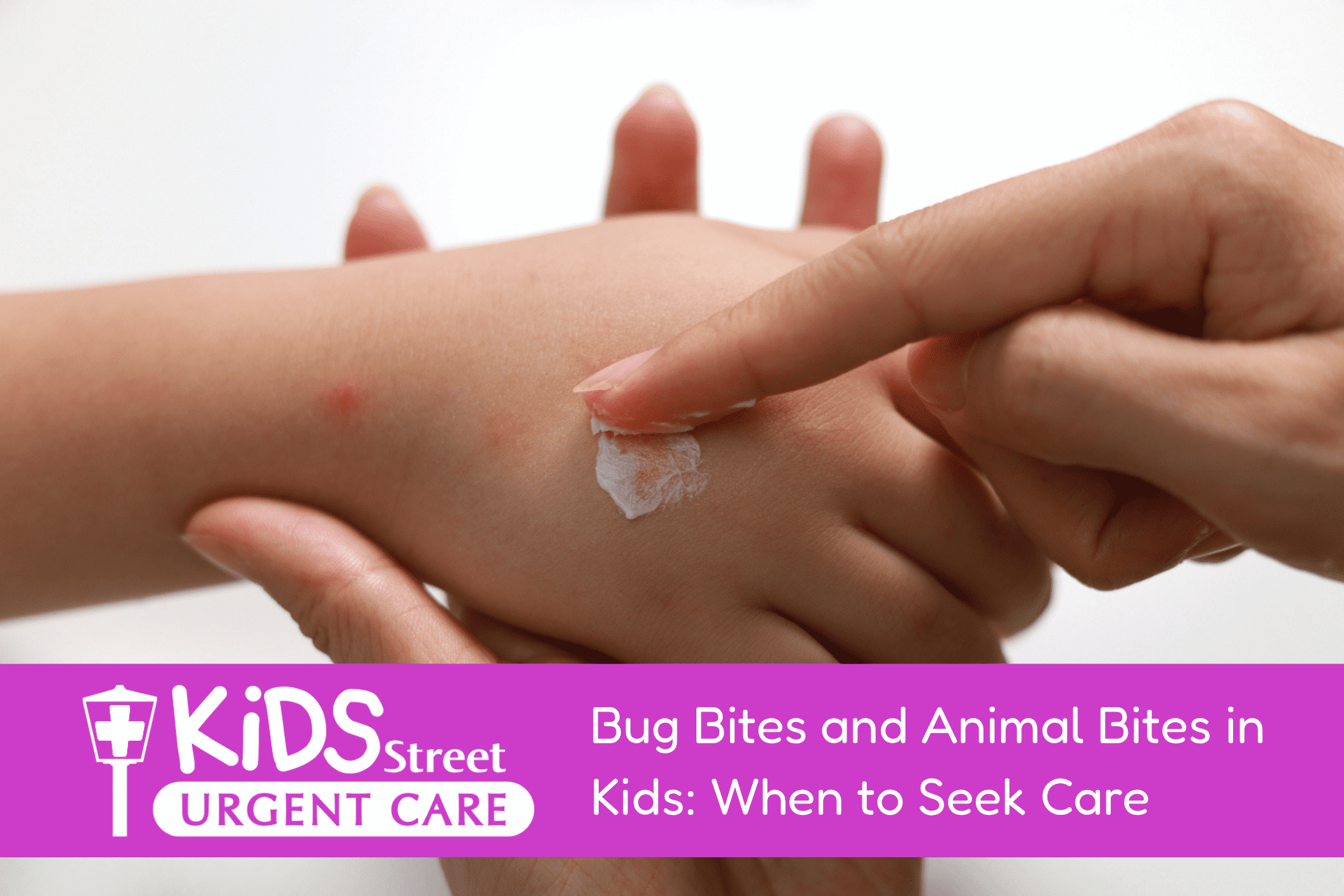 Mom putting bug bite medicine on a kids hand. Featured image for Bug Bites and Animal Bites in Kids: When to Seek Care blog post.